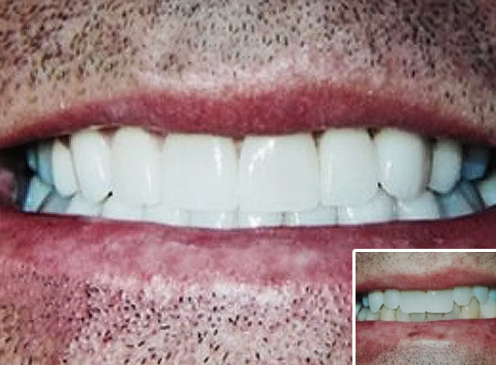 Veneers before and after