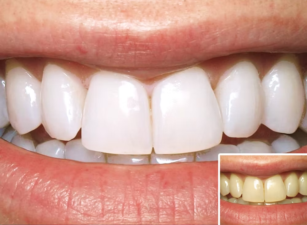 Teeth whitening before and after