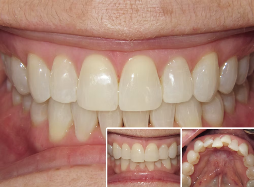 Invisalign before and after