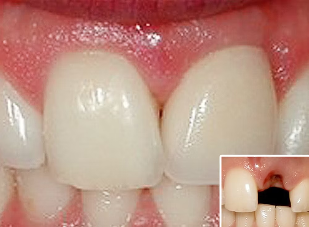 Dental implant before and after